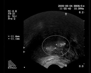 УЗ-картина предстательной железы: два гиперэхогенных участка ткани предстательной железы после ВЛК